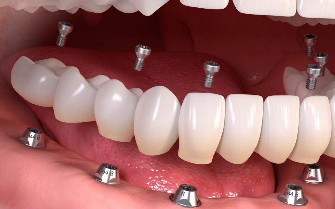 jellemzői fogak kezelésére közben cukorbetegség