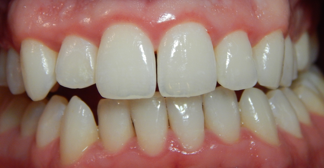 periodontitis kezelése cukorbetegeknél