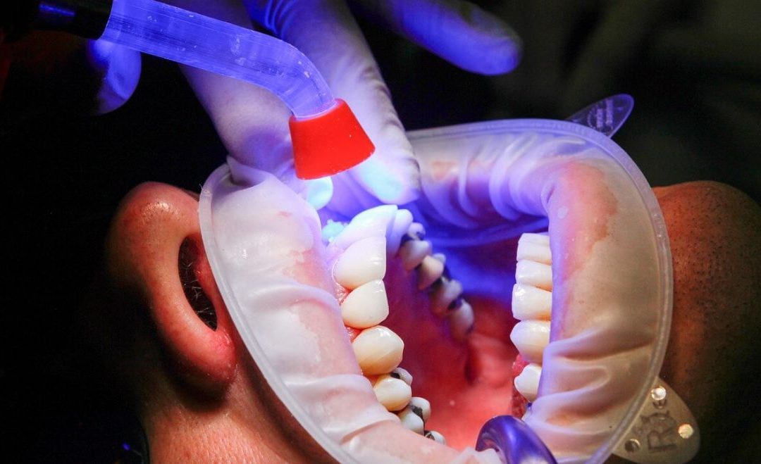 Foghúzás után – fontos tanácsok a fogorvostól