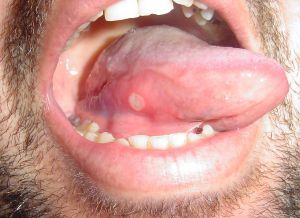 szájpadlás a szájban vörös foltok kezelése
