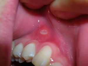 Fogászati cikkek Gennyet okozhat a szájból