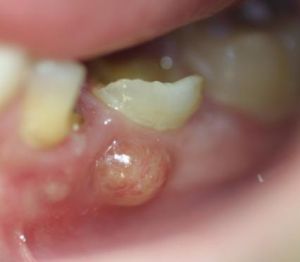 Amit a gennyes fogról tudni érdemes – a fogtályog tünetei és kezelése