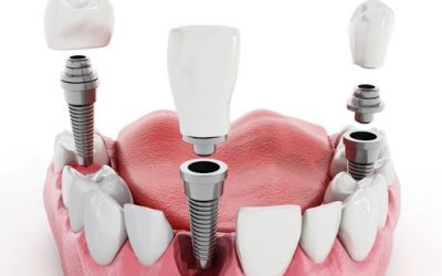 Valósak-e a fogimplantátum hátrányaival és veszélyeivel kapcsolatos félelmek?