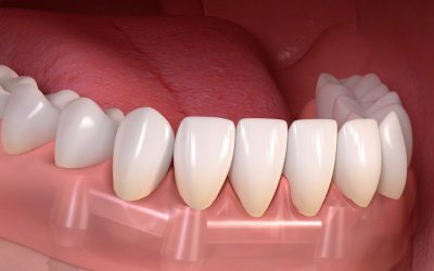 Fix fogsor: a megbízható, tartós, kényelmes kivehető fogsor