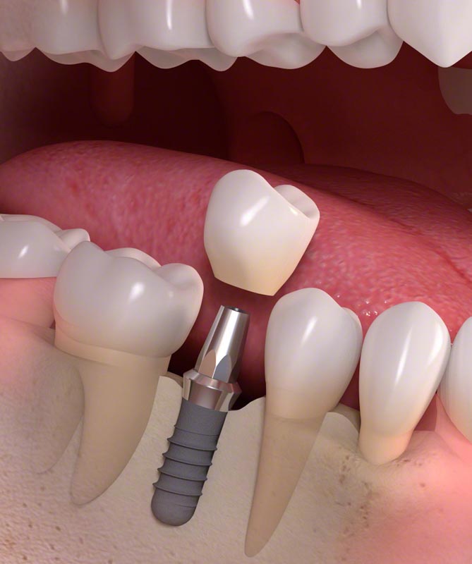 implantációs fogpótlás implantációs fogpótlás
