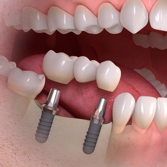 implantációs hídpótlás implantációs hídpótlás