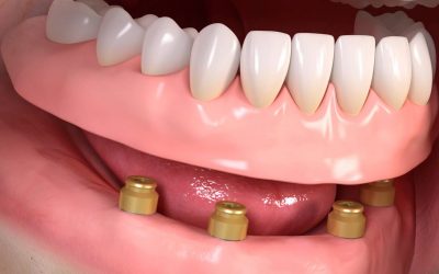 Kivehető fogsor rögzítése, fajtái és előnyei