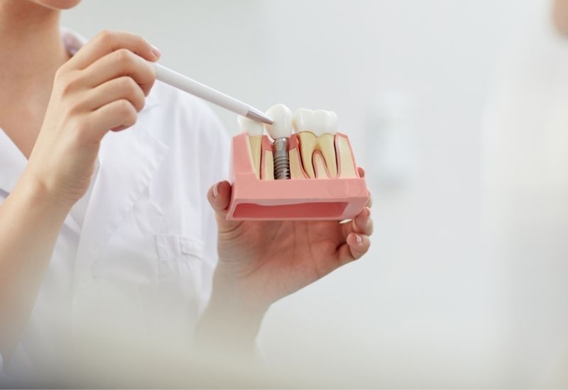 A fogimplabtáció sikerességében kritikus szerepe van az implantátum ideális pozicionálásának
forrás: