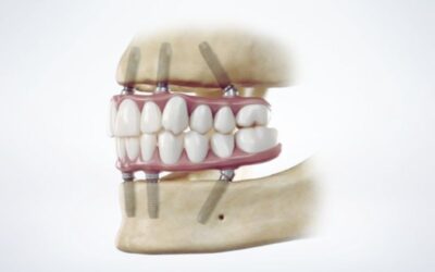 All-on-4 fogpótlás: rögzített fogsor teljes foghiány esetén