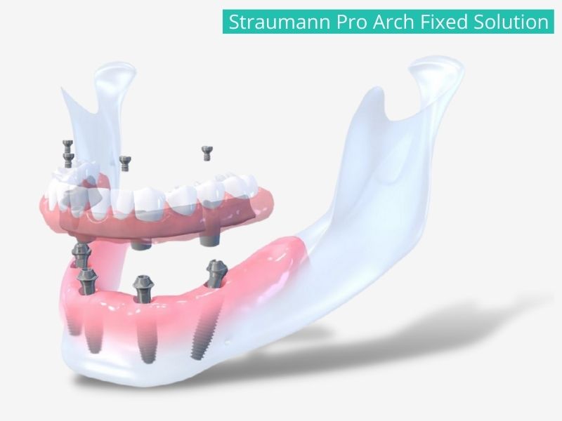 Ha a csontállomány pusztulása nagyobb mértékű, 6 implantátumra is készíthető rögzített fogsor