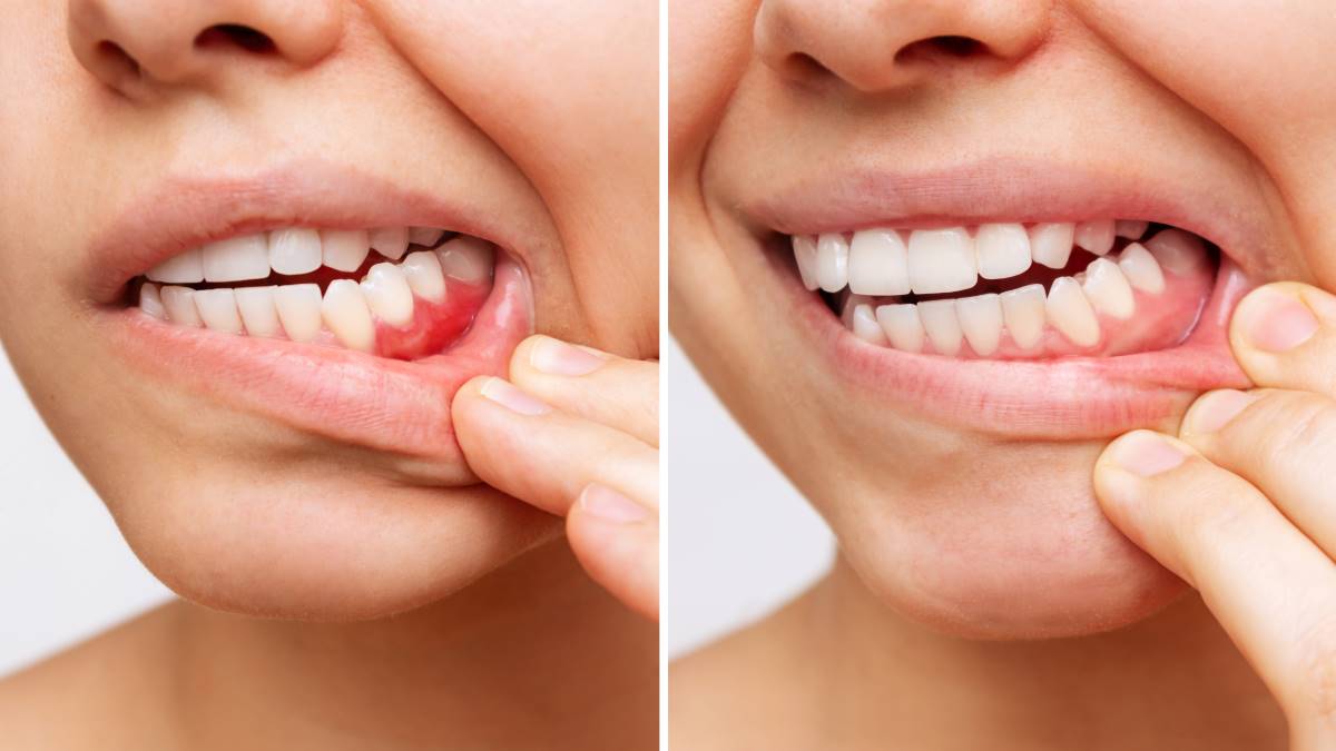 az egészséges íny rózsaszín és szorosan tapad a fogakhoz