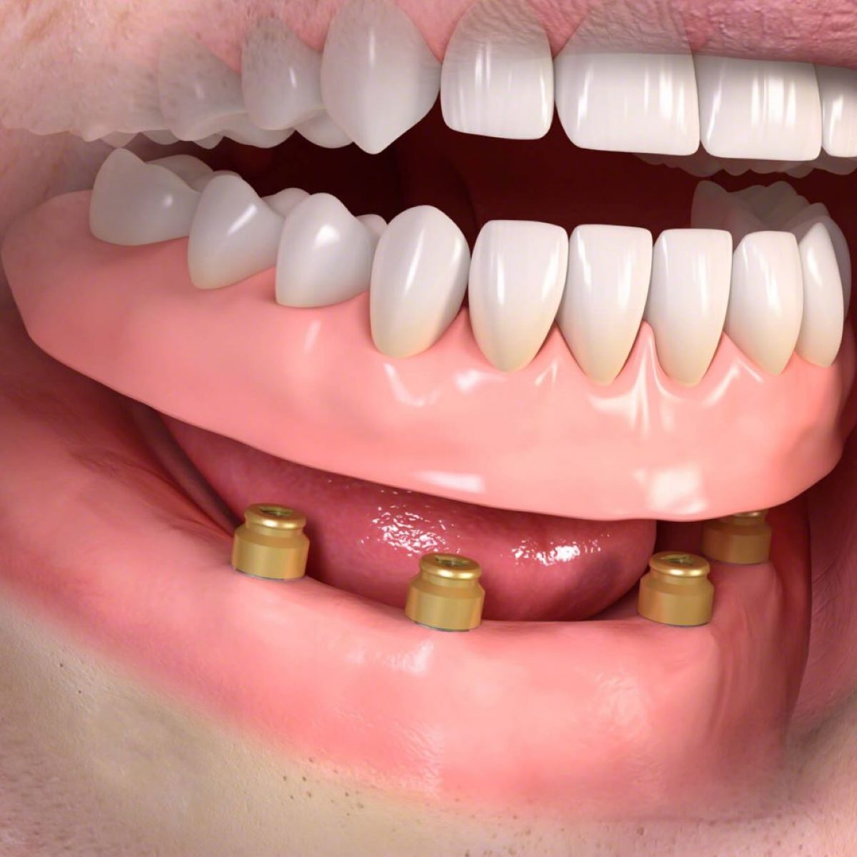a szájpadlás nélküli fogsor fogimplantátumok beültetésével valósítható meg