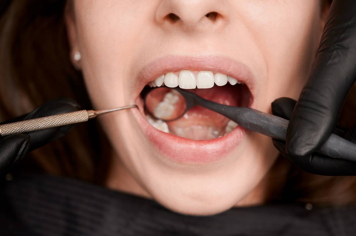 Fogtömés árak - hogyan kalkuláljunk? - Dentpoint