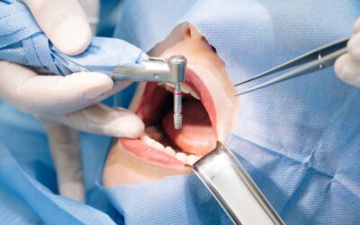 Milyen fogászati problémákkal forduljunk implantológushoz?