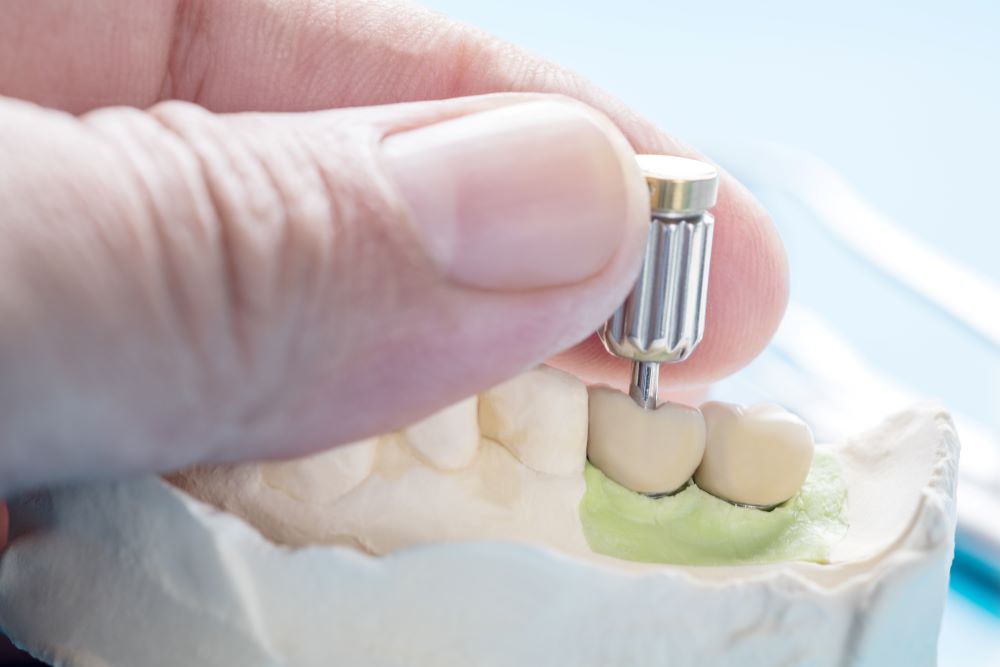 Megbízható implantológus Budapesten a Dentpointnál: kérjen időpontot!