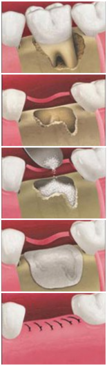 csontpótló eljárások