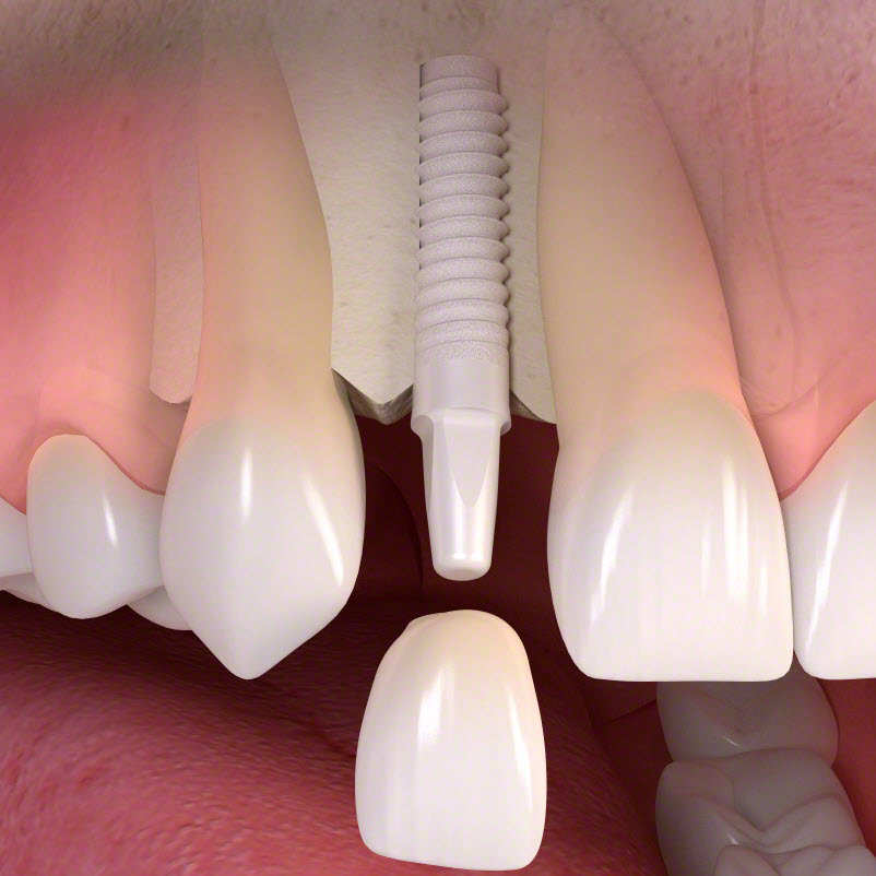 implantatumok-kozti-tavolsag A fogászati implantátum elhelyezése során kiemelten fontos a megfelelő pozicionálás.