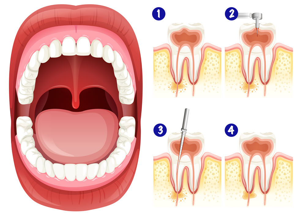 gyokerkezeles-menete A gyökérkezelés célja a gyulladt, fertőzött vagy elhalt fogbél eltávolítása, valamint a gyökércsatornák precíz tisztítása és lezárása.