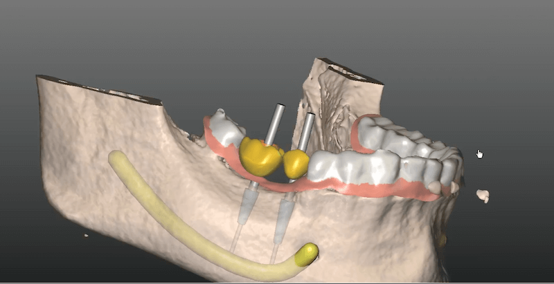 Smart Guide CT navigált sebészeti rendszer
