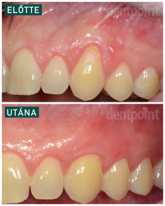 előtte utána ínyrecesszió