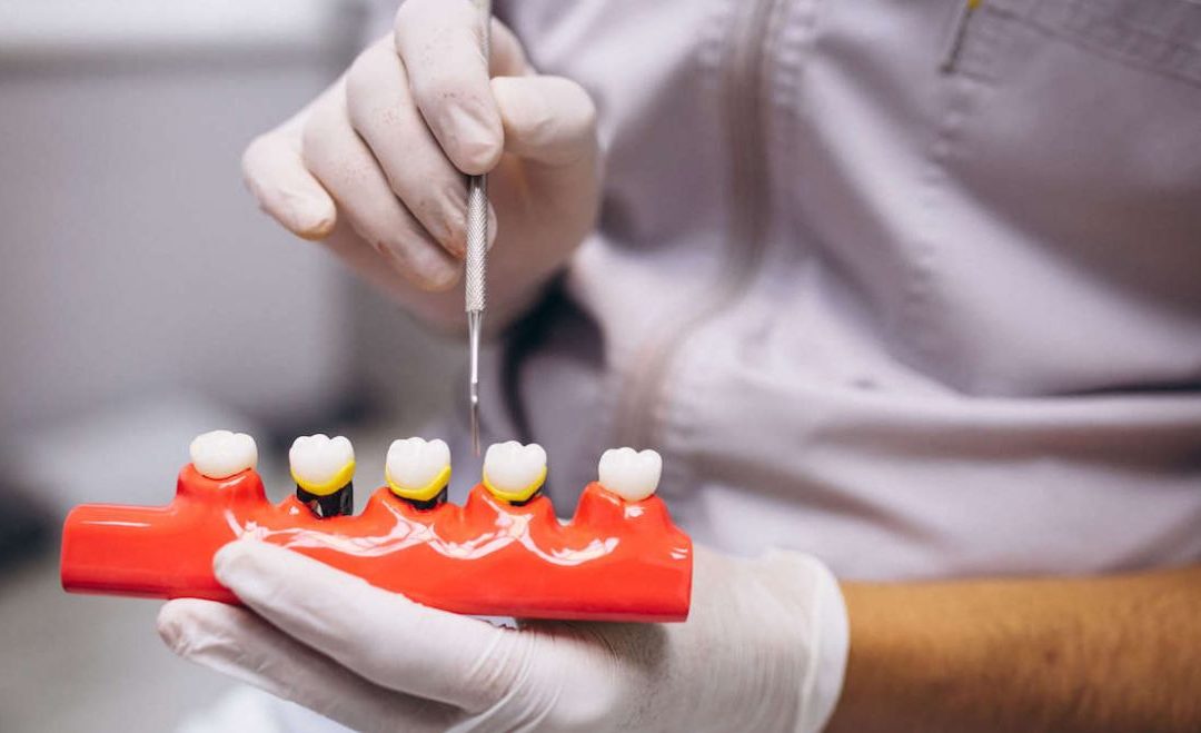 Mit tegyünk, ha a fog implantátum mozog? Tanácsadás a Dentpointnál.