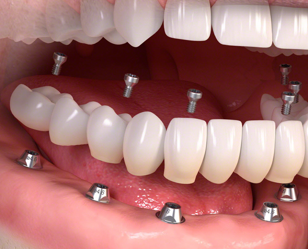 A fogászati implantátumok elhelyezését gondosan meg kell tervezni