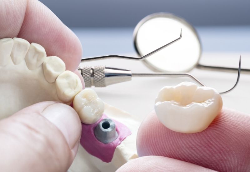 Fogkorona illesztése előzetesen beültetett fogimplantátumra