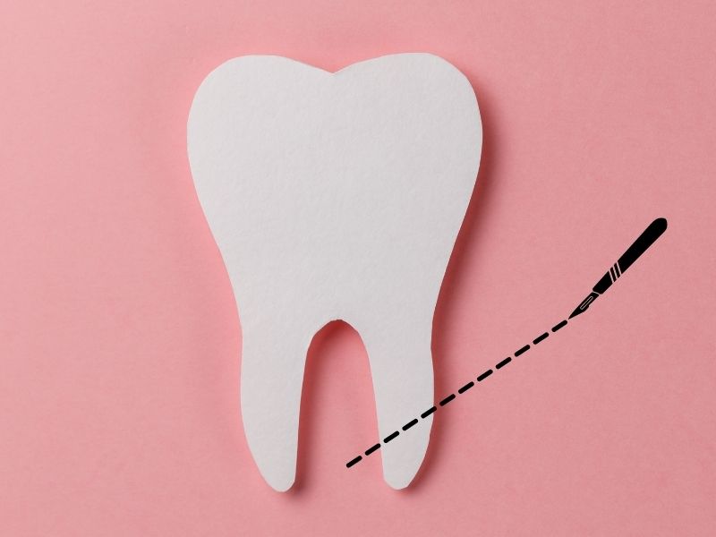 A gyökércsúcs rezekció utolsó esély a fog megmentésére