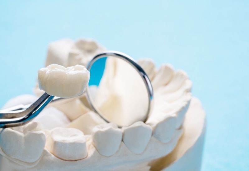 Fogkorona saját fogra