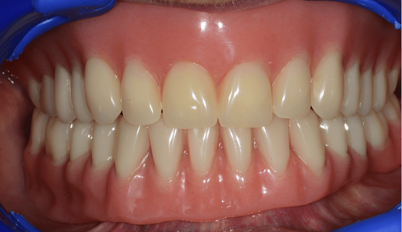 műfogsor szájüregbe helyezve