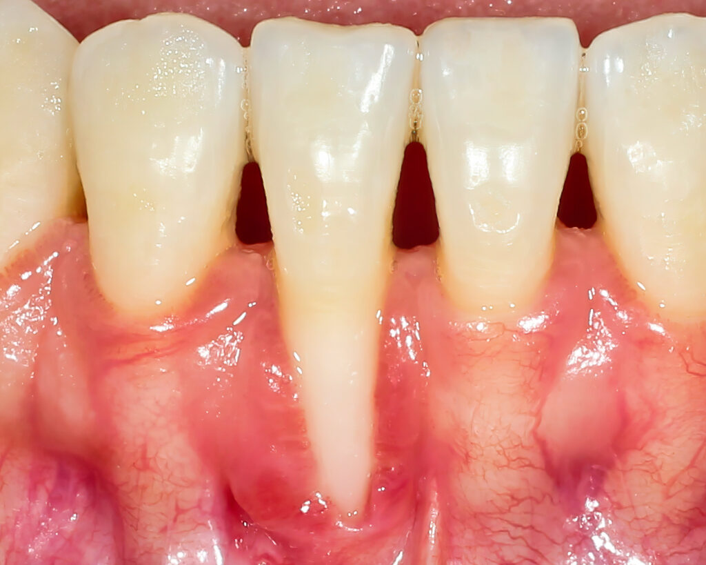 A szabaddá vált fognyak érzékeny