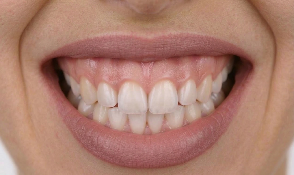 Ínymosolyról – angolul gummy smile – akkor beszélünk, amikor mosolygás közben a felső fogak felett az ínyből az átlagosnál nagyobb rész látszik